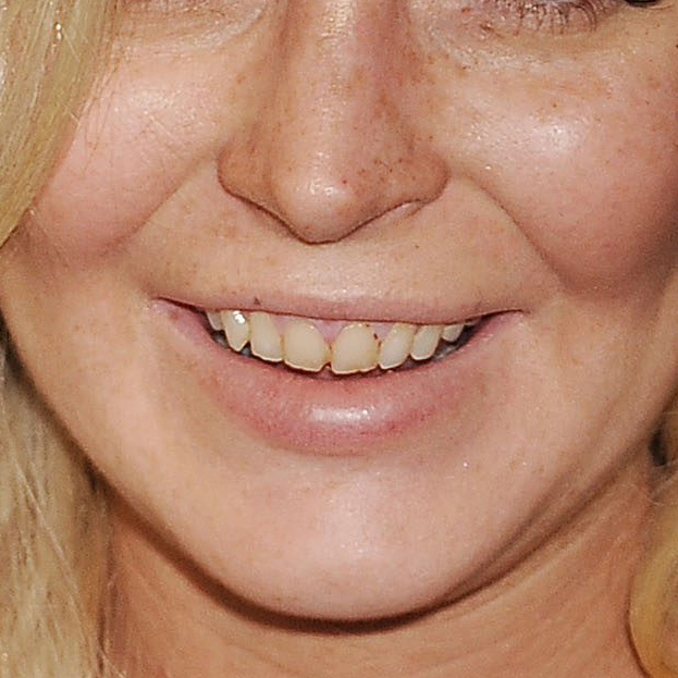 Lindsay chwali się nowymi zębami!